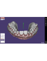 EXOCAD Software Bite Splint Module