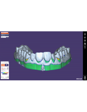 EXOCAD Software Bite Splint Module