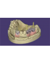 EXOCAD Implant Module