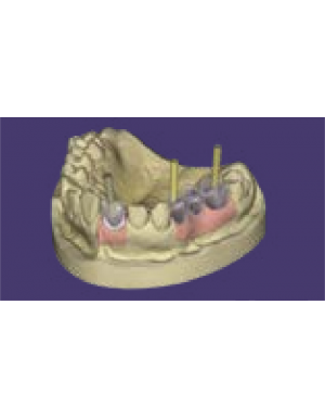 EXOCAD Implant Module