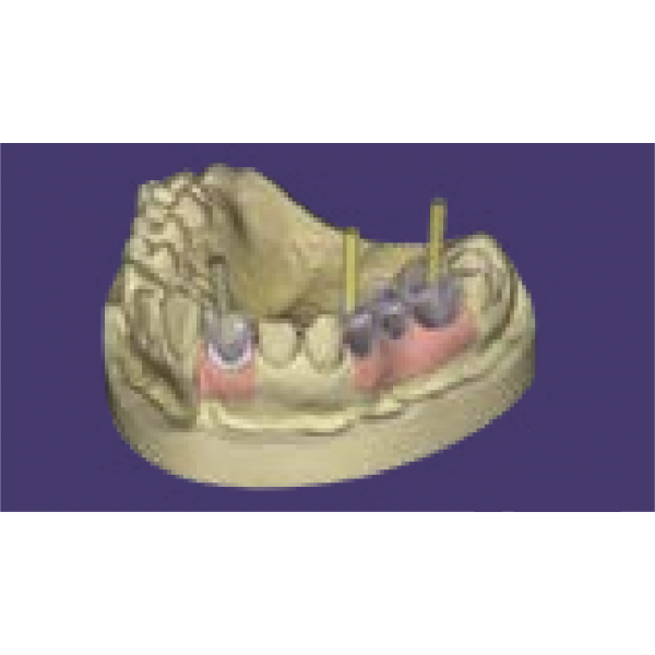 EXOCAD Implant Module